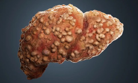 Низкий доход и высокий риск: как финансовые проблемы ведут к циррозу печени