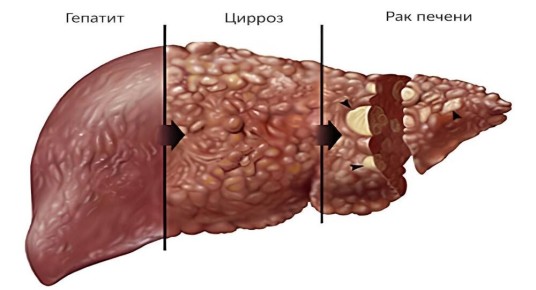 Заболевания печени: от гепатита до цирроза